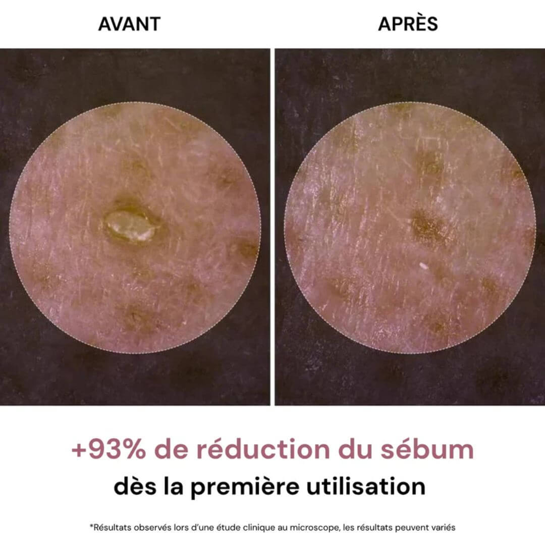 Peel Shot : Fini les points noirs, place à la peau nette.