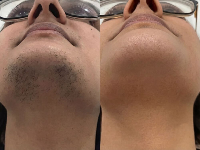 Ma barbe me complexait énormément. Après 3 mois...