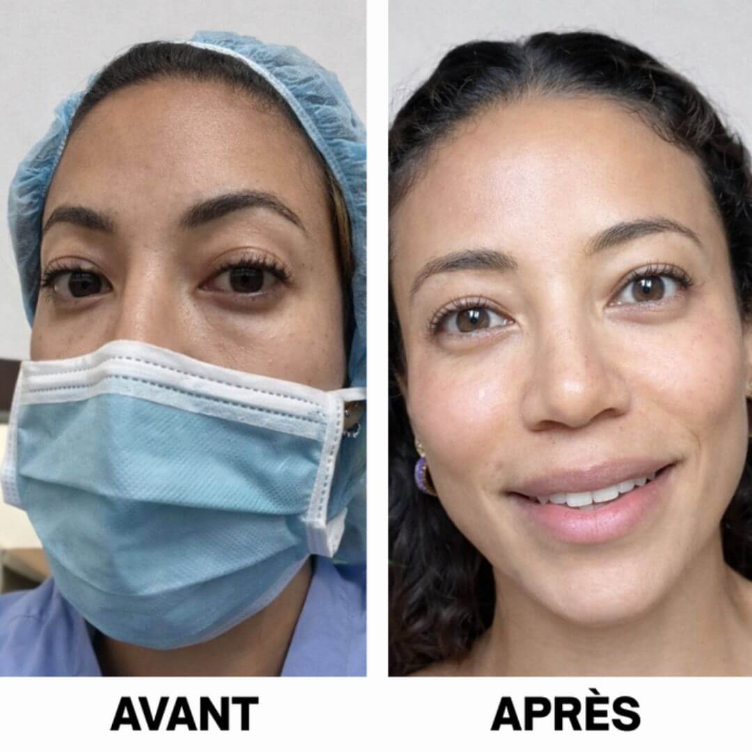 Patchs Hydrogel Peptide & Collagène